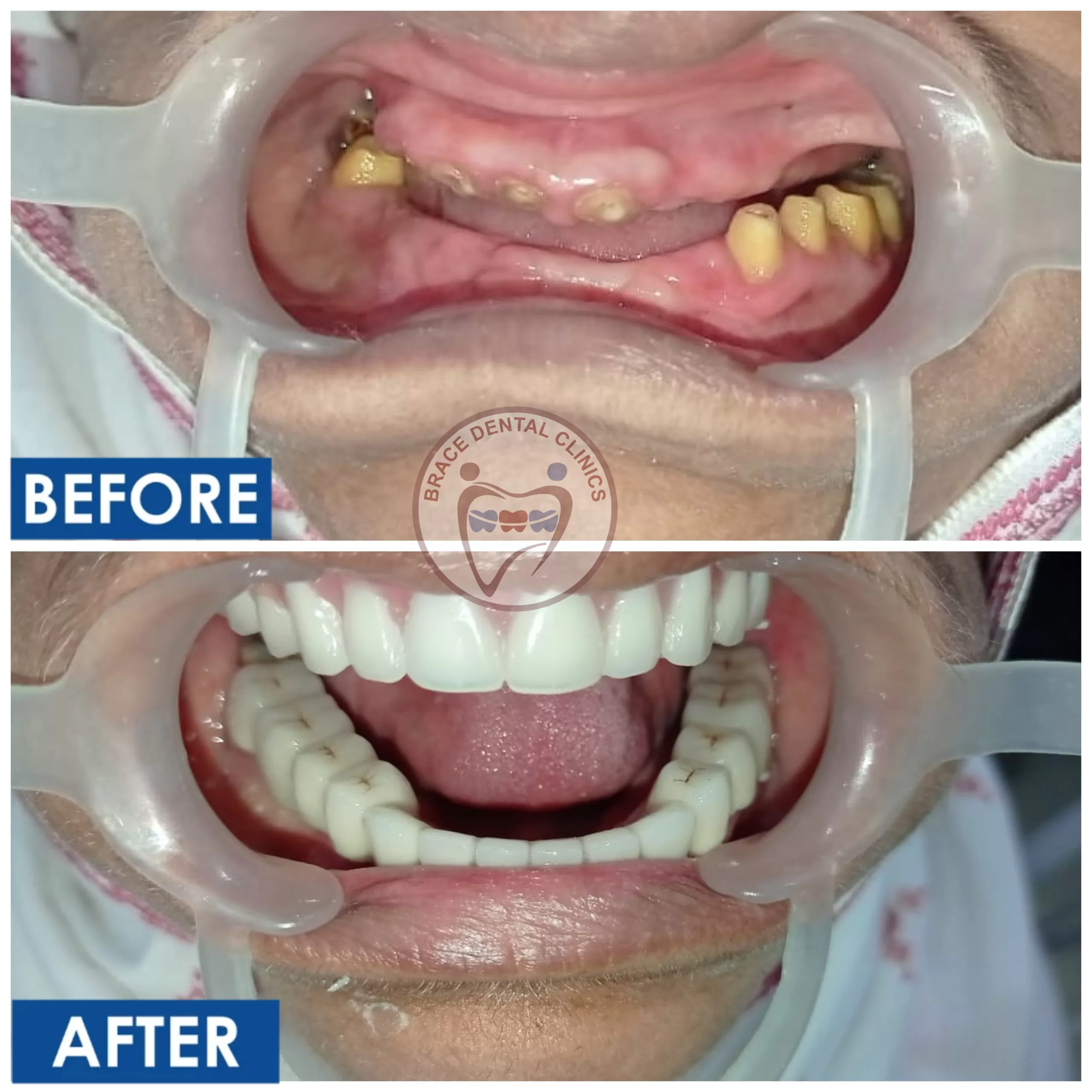 Fixed Teeth In Hyderabad, Top Dental Clinic in Hyderabad
