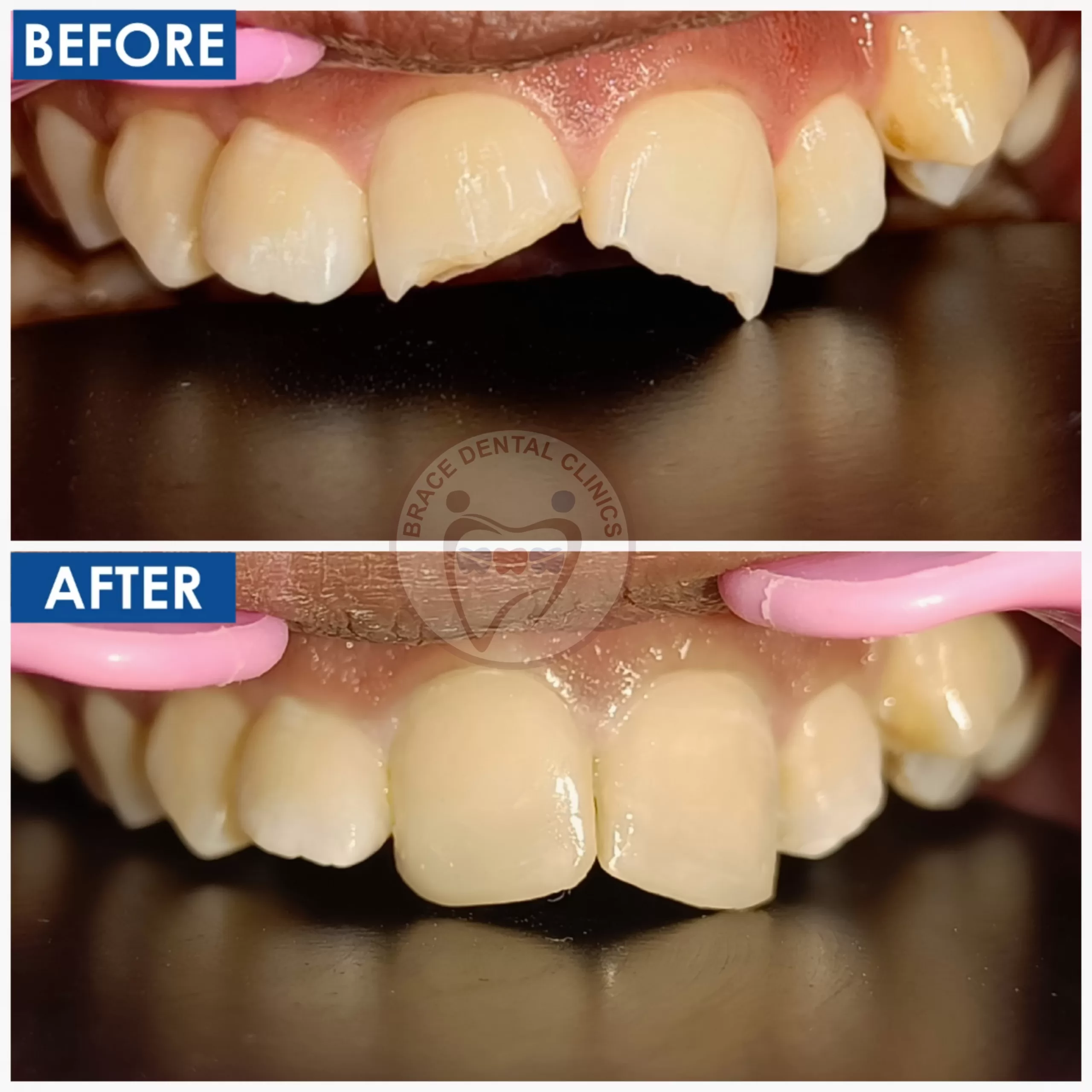 Smile Correction in Hyderabad, Brace Dental Clinic