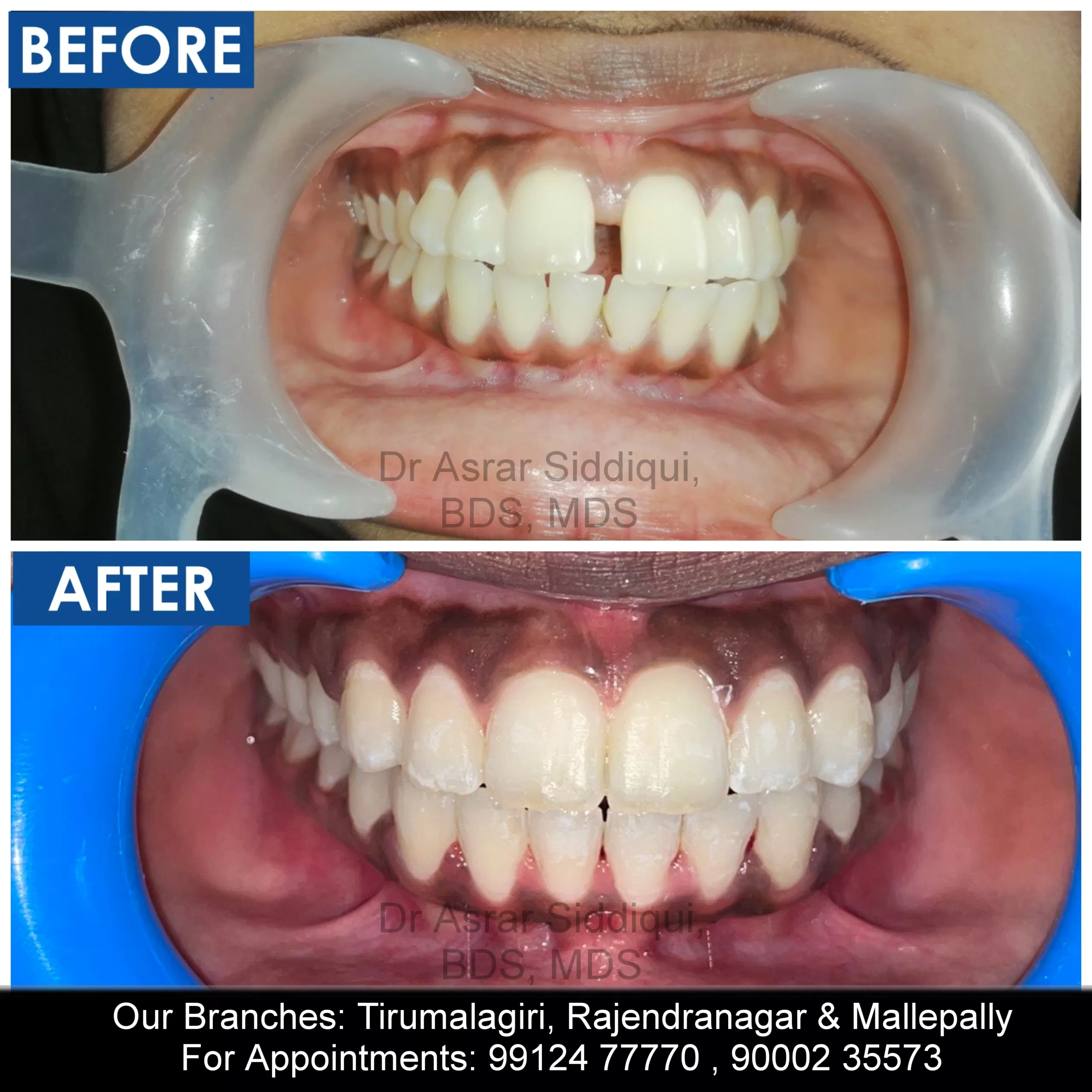 Teeth Spacing Treatment in Hyderabad, Brace Dental