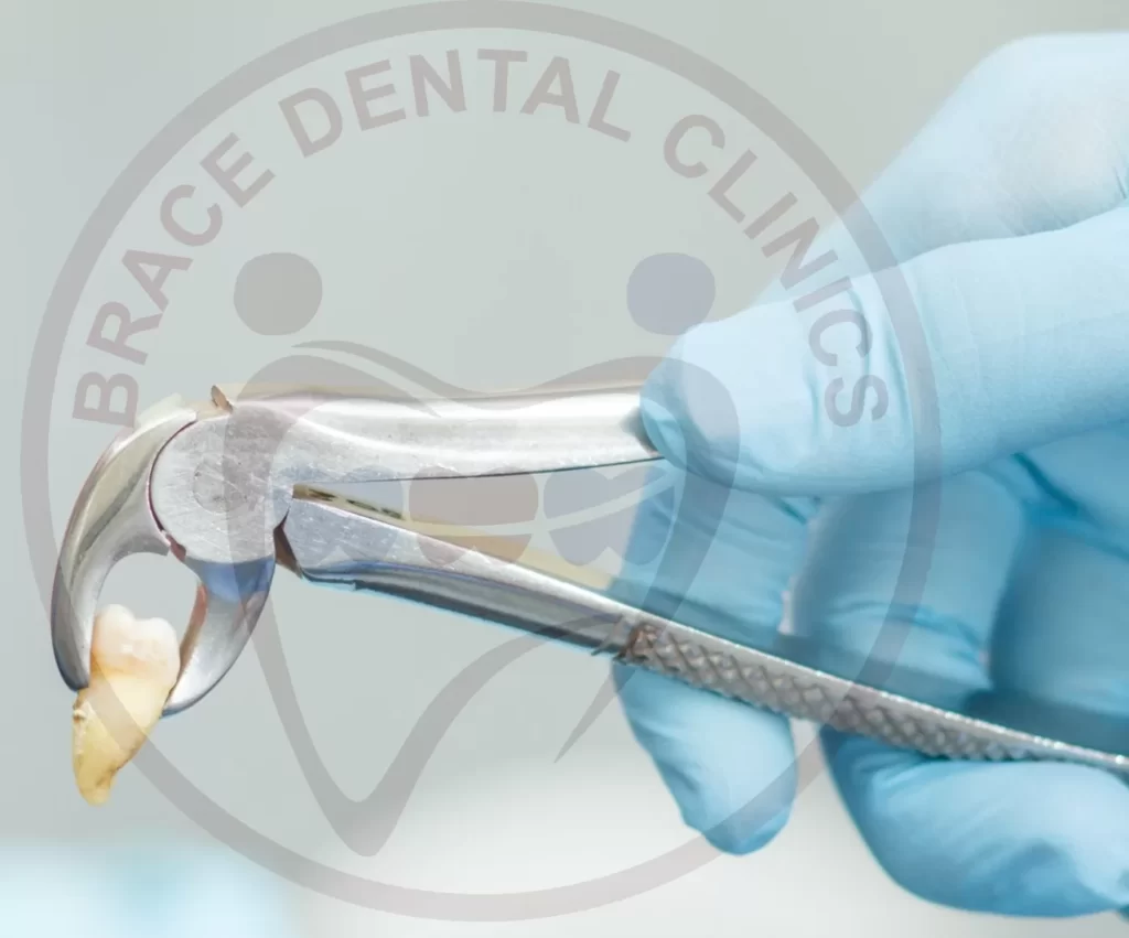 Painless Tooth Removal in Hyderabad