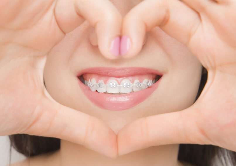 ceramic braces, Dr Asrar Siddiqui, Brace Dental Clinic