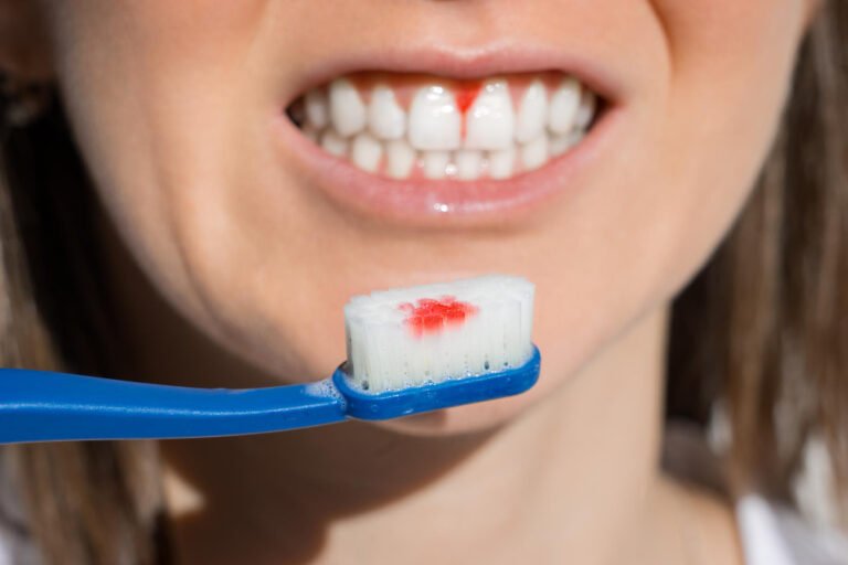 Bleeding Gums Brace Dental