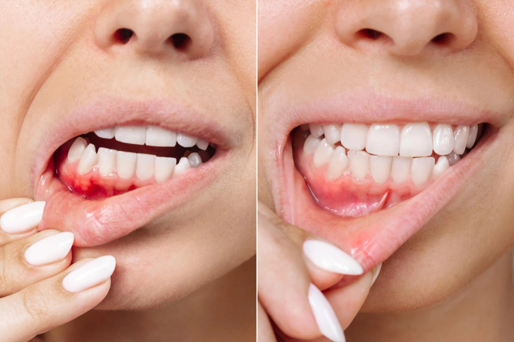 what to do for bleeding gums ?